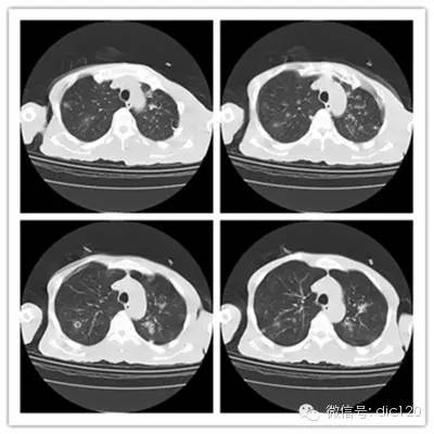 【病例】金葡菌肺炎典型病例+典型表现1例CT 【病例】金葡菌肺炎典型病例+典型表现1例CT