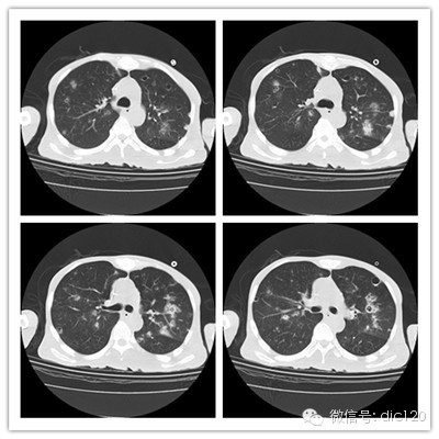 【病例】金葡菌肺炎典型病例+典型表现1例CT 【病例】金葡菌肺炎典型病例+典型表现1例CT