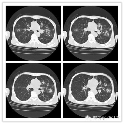 【病例】金葡菌肺炎典型病例+典型表现1例CT 【病例】金葡菌肺炎典型病例+典型表现1例CT