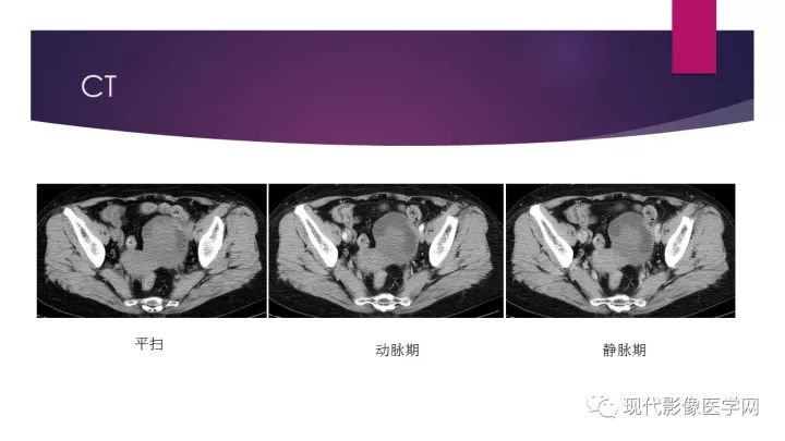 【病例】卵巢囊性腺纤维瘤1例CT及MR影像表现
