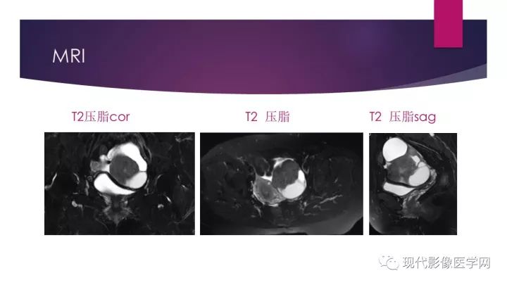 【病例】卵巢囊性腺纤维瘤1例CT及MR影像表现