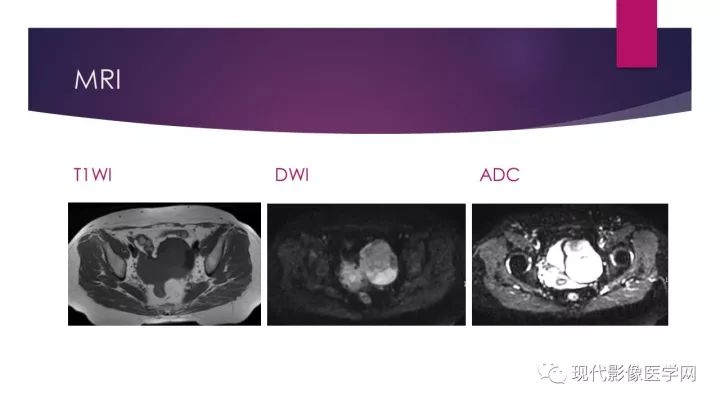 【病例】卵巢囊性腺纤维瘤1例CT及MR影像表现