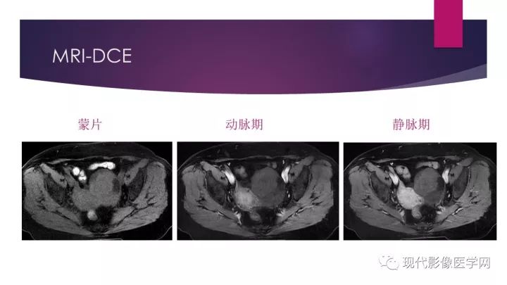 【病例】卵巢囊性腺纤维瘤1例CT及MR影像表现