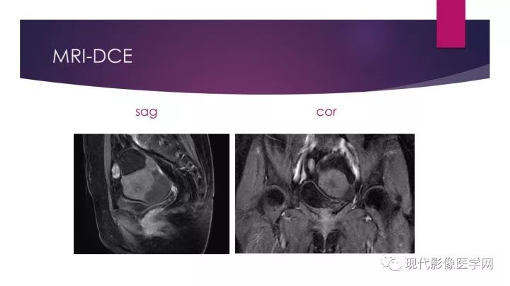 【病例】卵巢囊性腺纤维瘤1例CT及MR影像表现