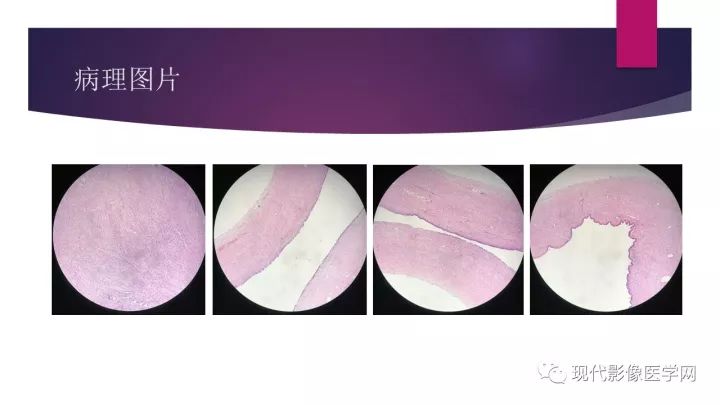 【病例】卵巢囊性腺纤维瘤1例CT及MR影像表现