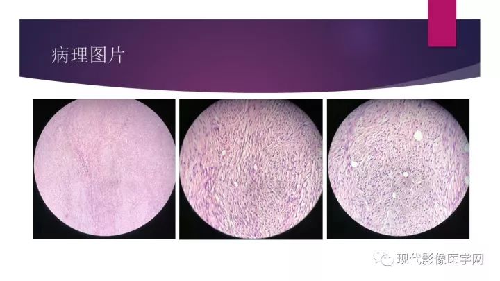 【病例】卵巢囊性腺纤维瘤1例CT及MR影像表现