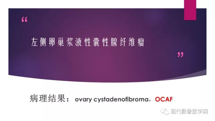 【病例】卵巢囊性腺纤维瘤1例CT及MR影像表现