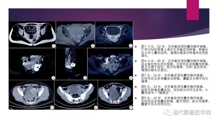 【病例】卵巢囊性腺纤维瘤1例CT及MR影像表现