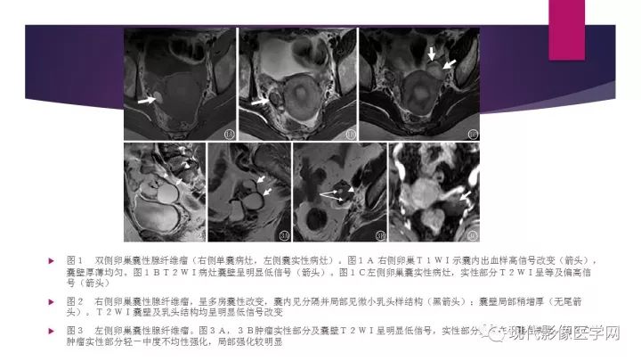 【病例】卵巢囊性腺纤维瘤1例CT及MR影像表现