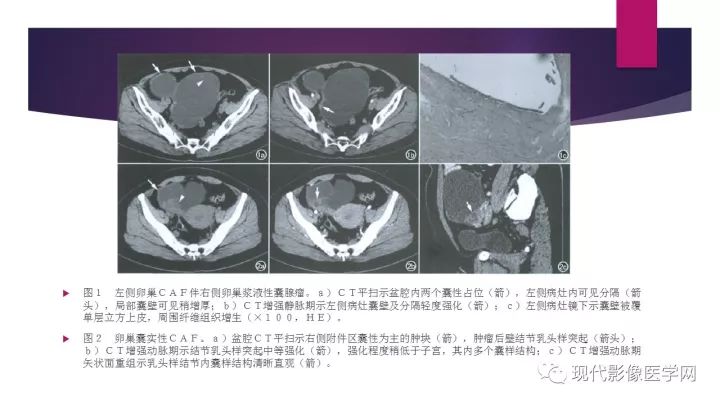 【病例】卵巢囊性腺纤维瘤1例CT及MR影像表现