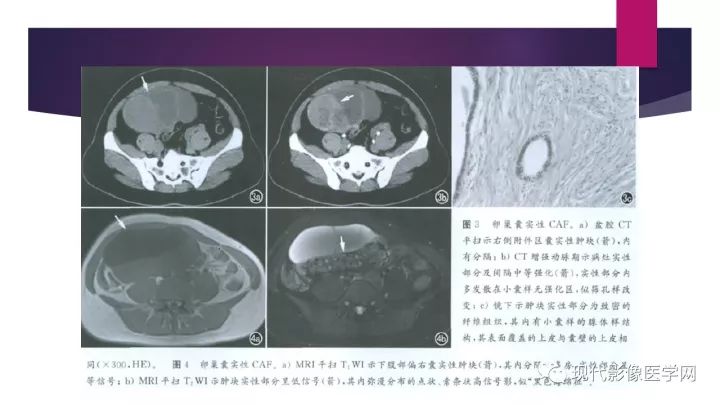 【病例】卵巢囊性腺纤维瘤1例CT及MR影像表现