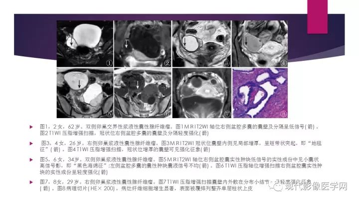 【病例】卵巢囊性腺纤维瘤1例CT及MR影像表现