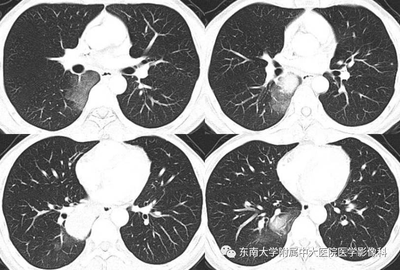 【病例】成人肺母细胞瘤1例CT影像表现