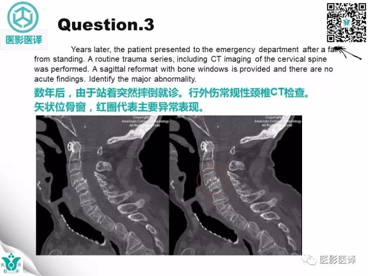 【病例】透析相关性淀粉样变1例X线CT及MR
