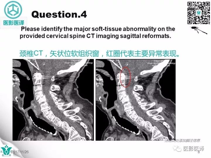 【病例】透析相关性淀粉样变1例X线CT及MR