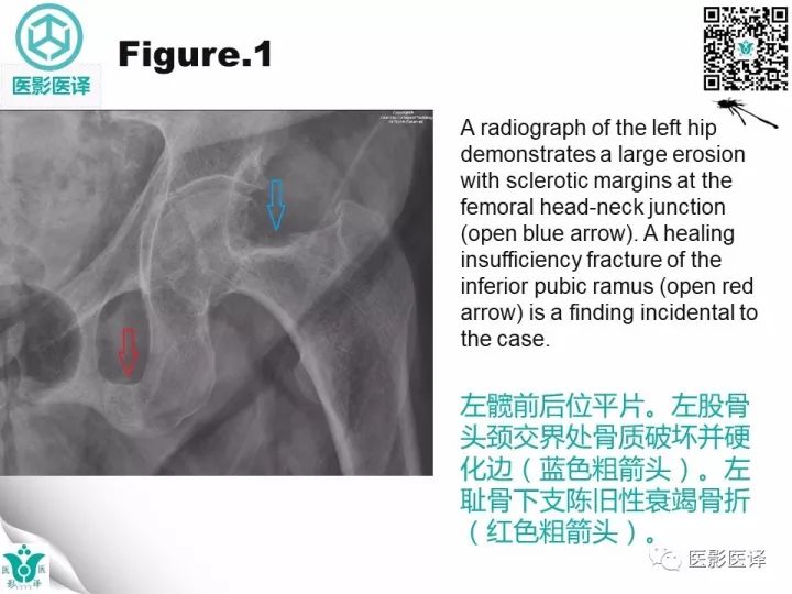 【病例】透析相关性淀粉样变1例X线CT及MR