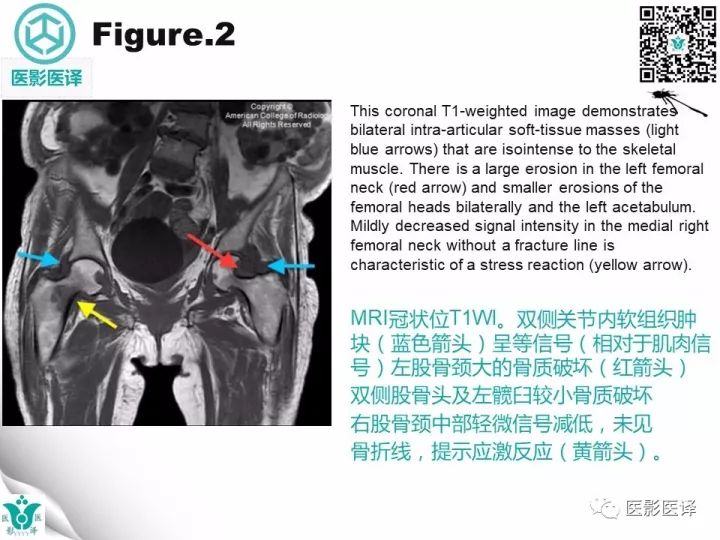 【病例】透析相关性淀粉样变1例X线CT及MR