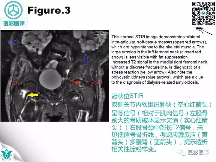 【病例】透析相关性淀粉样变1例X线CT及MR