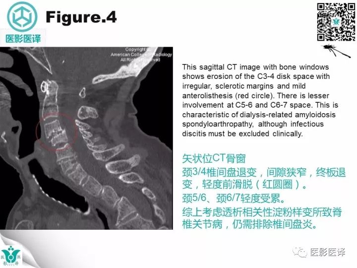 【病例】透析相关性淀粉样变1例X线CT及MR