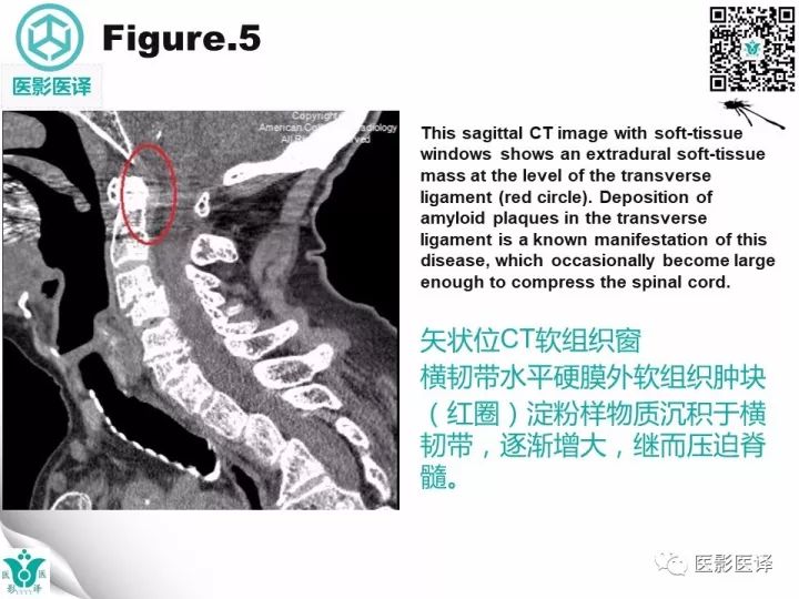 【病例】透析相关性淀粉样变1例X线CT及MR