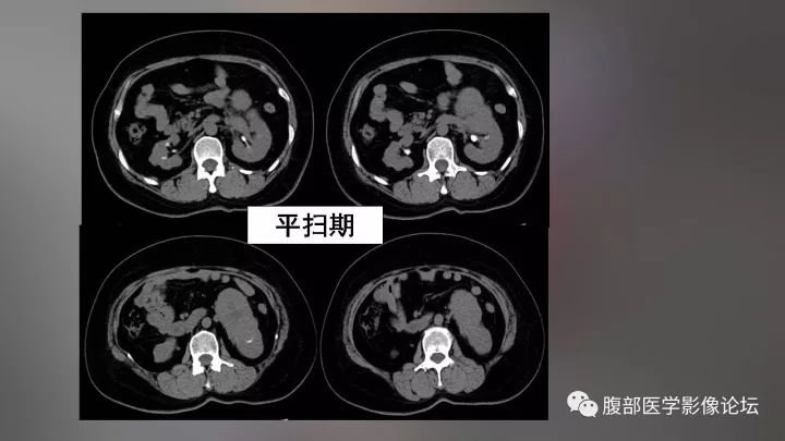 【病例】左肾嗜酸性细胞腺瘤1例CT影像表现