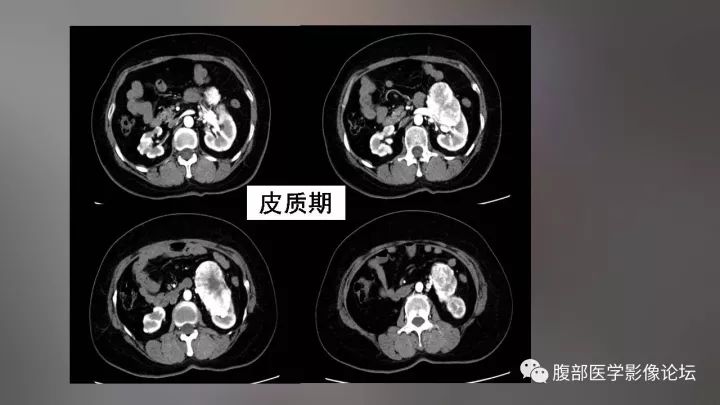 【病例】左肾嗜酸性细胞腺瘤1例CT影像表现