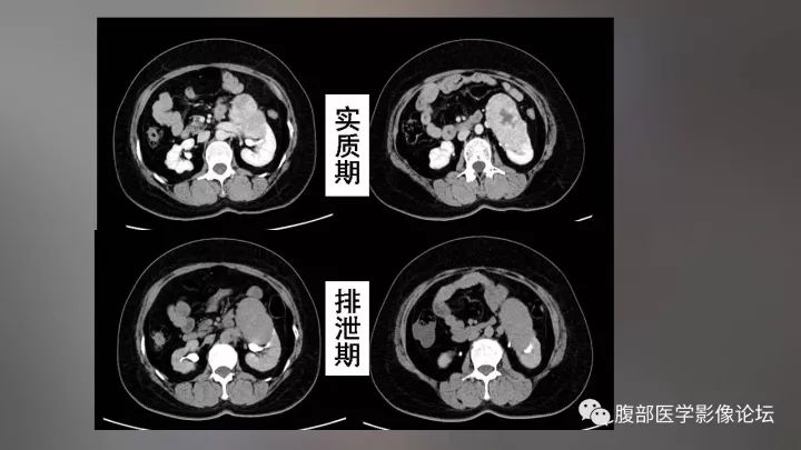 【病例】左肾嗜酸性细胞腺瘤1例CT影像表现