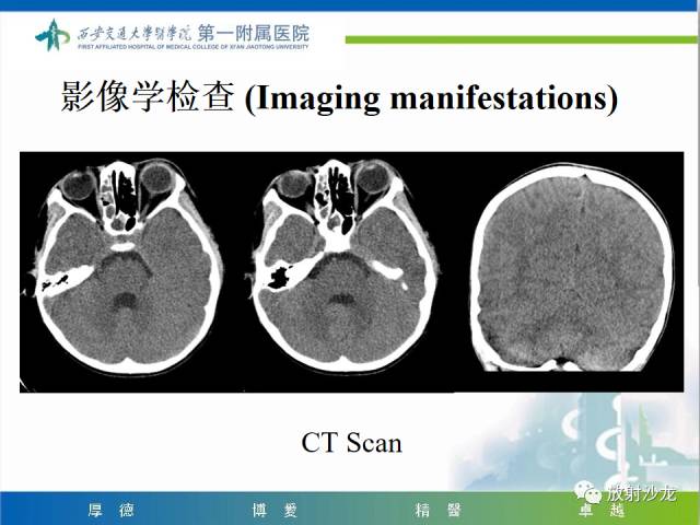 【病例】山豆根中毒1例CT及MR影像表现