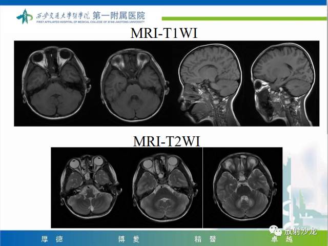 【病例】山豆根中毒1例CT及MR影像表现