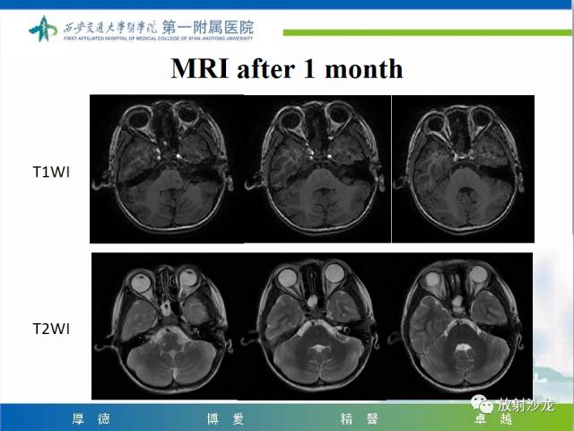 【病例】山豆根中毒1例CT及MR影像表现