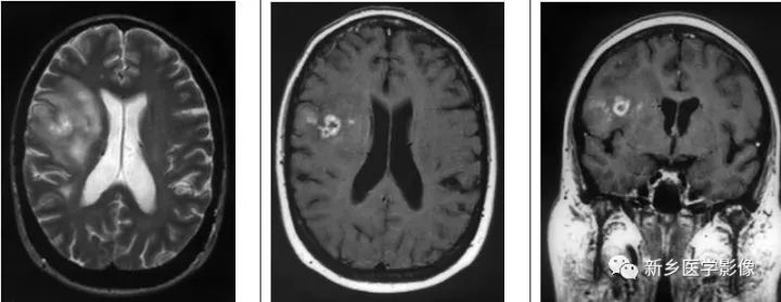 颅内12种环形强化病变总结 颅内12种环形强化病变总结