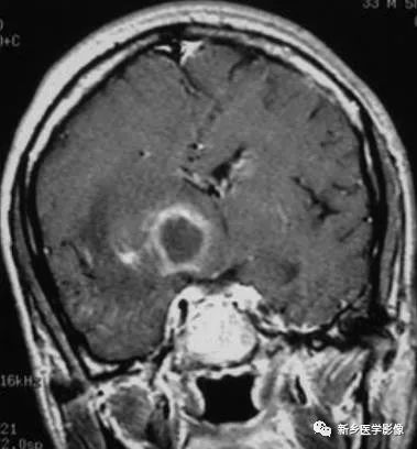 颅内12种环形强化病变总结 颅内12种环形强化病变总结