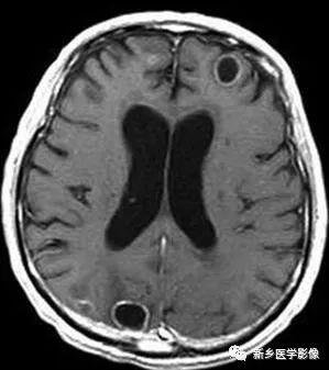 颅内12种环形强化病变总结 颅内12种环形强化病变总结