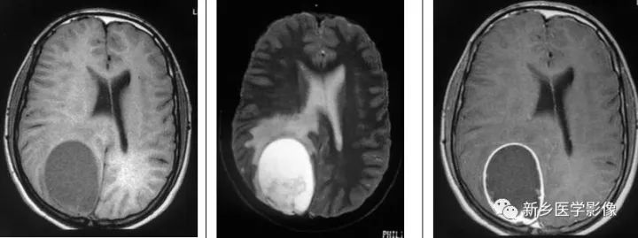 颅内12种环形强化病变总结 颅内12种环形强化病变总结