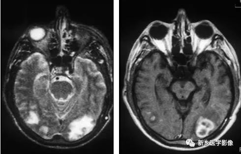 颅内12种环形强化病变总结 颅内12种环形强化病变总结