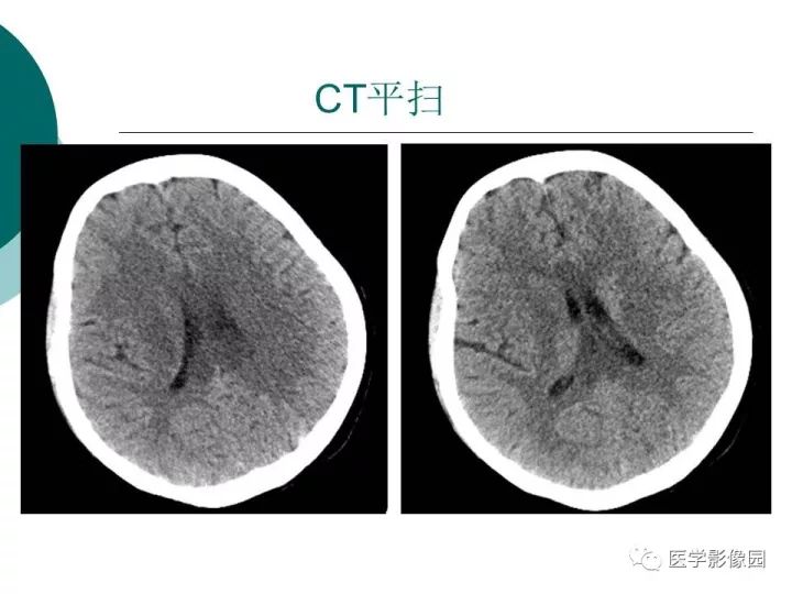 【病例】狼疮性脑病1例MR影像表现