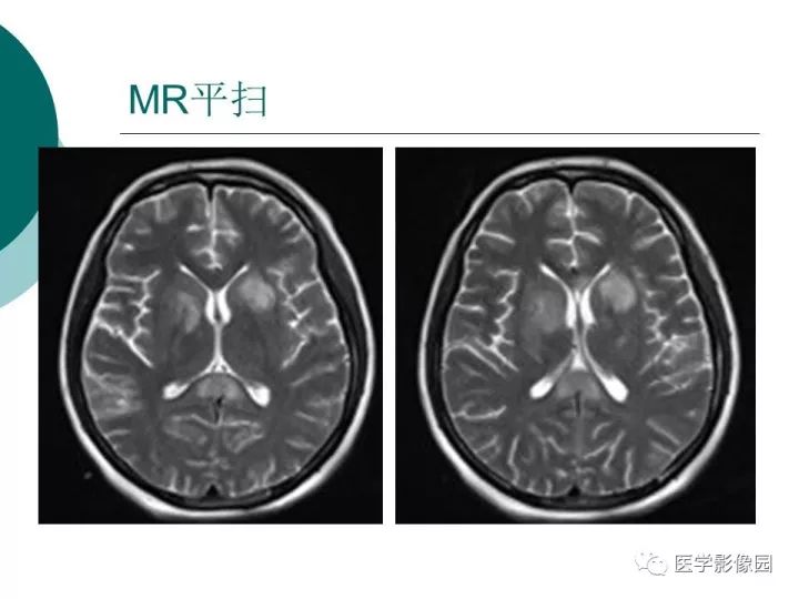 【病例】狼疮性脑病1例MR影像表现