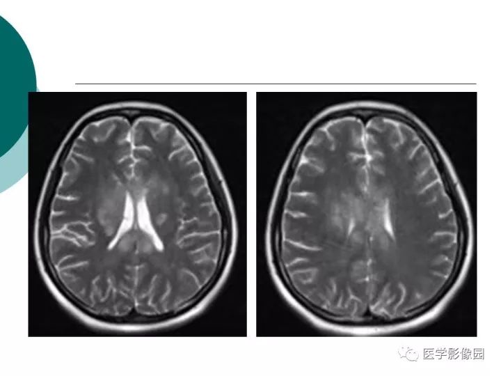 【病例】狼疮性脑病1例MR影像表现