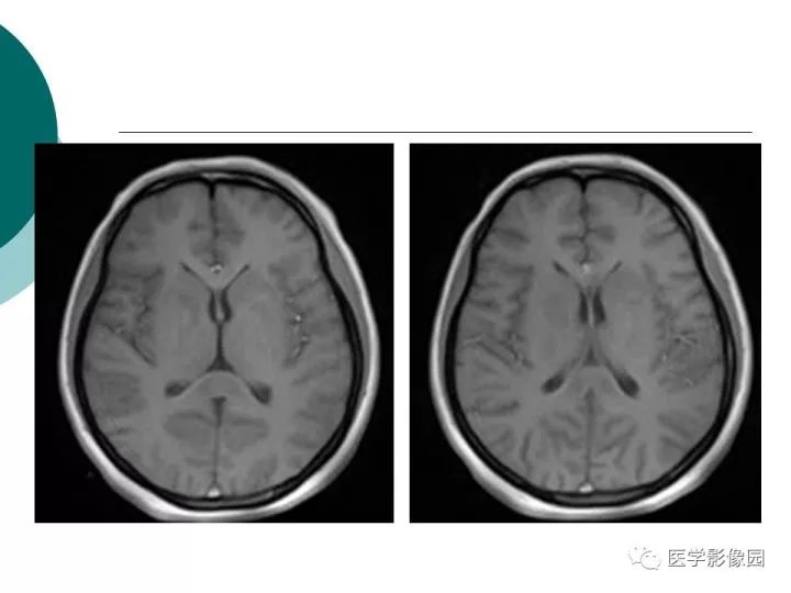 【病例】狼疮性脑病1例MR影像表现