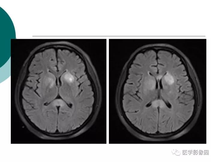 【病例】狼疮性脑病1例MR影像表现