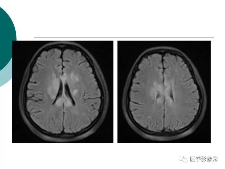 【病例】狼疮性脑病1例MR影像表现
