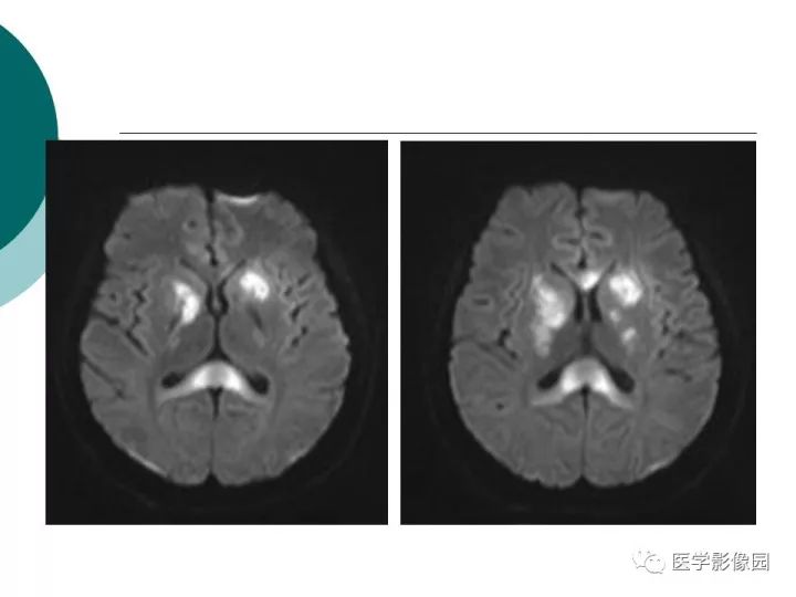 【病例】狼疮性脑病1例MR影像表现