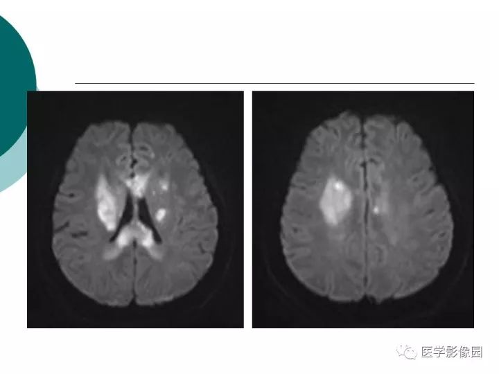 【病例】狼疮性脑病1例MR影像表现