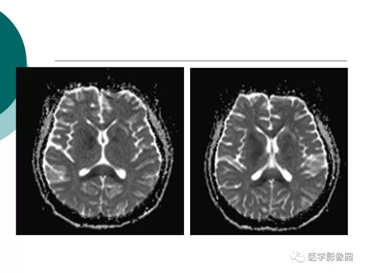 【病例】狼疮性脑病1例MR影像表现