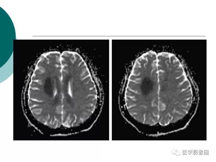 【病例】狼疮性脑病1例MR影像表现
