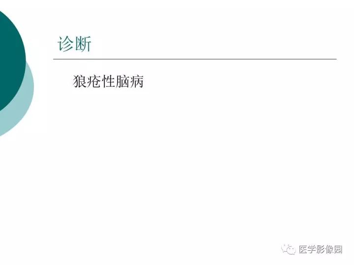 【病例】狼疮性脑病1例MR影像表现