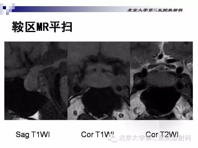 【病例】淋巴细胞性垂体炎1例MR影像表现
