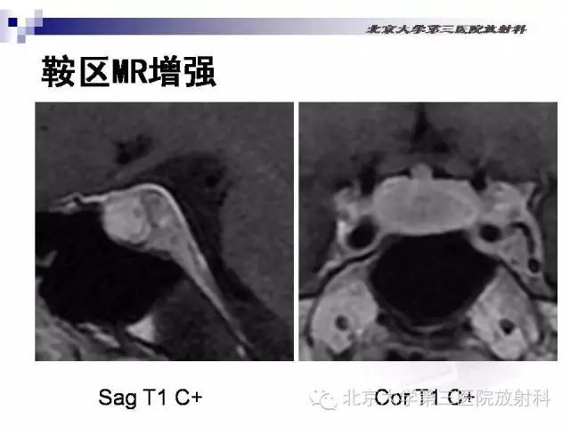 【病例】淋巴细胞性垂体炎1例MR影像表现