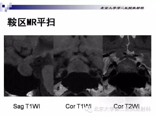 【病例】淋巴细胞性垂体炎1例MR影像表现