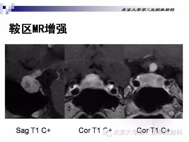 【病例】淋巴细胞性垂体炎1例MR影像表现